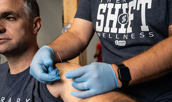 A therapist inserting dry needling needles into a patient's shoulder muscle